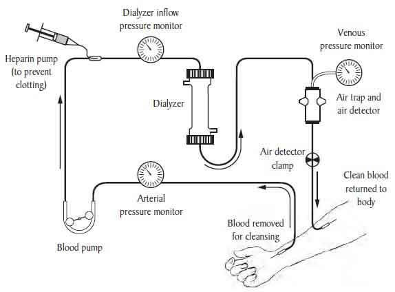 Dialysis